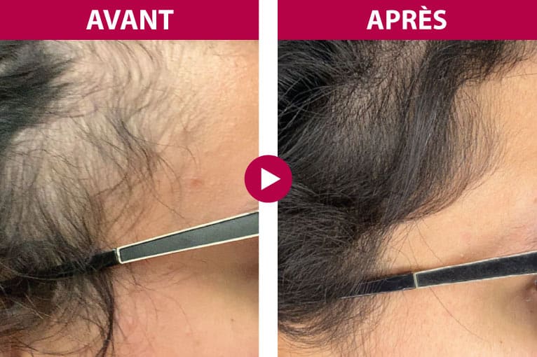 Résultat avant après Hair Summum femme