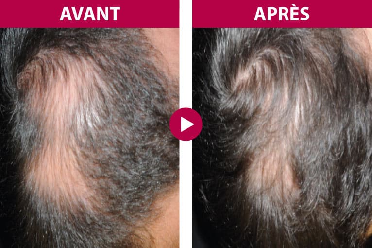 Résultat avant après Hair Summum homme